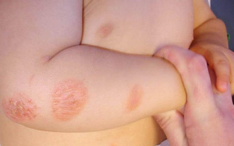 Trẻ em khi bị hắc lào cần làm gì? Những điều thiết yếu cần biết về bệnh hắc lào ở trẻ em.