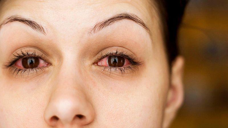 Đau mắt đỏ khi mang thai có thể là một vấn đề đáng lo ngại. Vậy bệnh này có gây nguy hiểm cho mẹ và thai nhi không? Cùng khám phá những biện pháp giúp mẹ bầu giảm đau mắt đỏ hiệu quả.