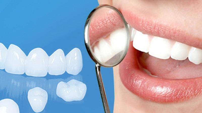 Có thể thực hiện bọc răng sứ lần thứ hai hay không? Những yếu tố cần lưu ý khi tiến hành bọc lại răng sứ.