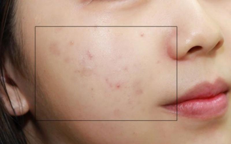 5 loại mặt nạ thiên nhiên giúp xóa mờ vết thâm chỉ sau 7 ngày
