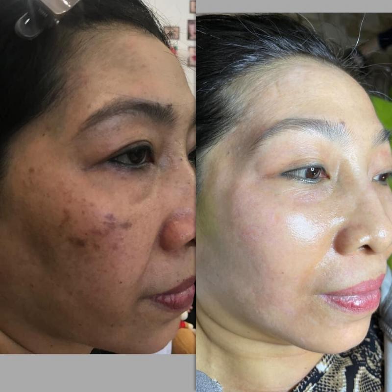 Top 9 Spa trị nám uy tín hàng đầu tại Quận 9, TP. HCM