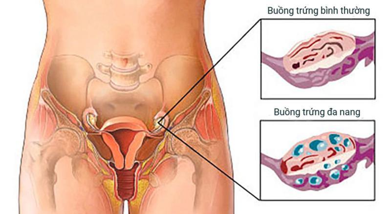 Top 6 Địa chỉ uy tín khám và điều trị buồng trứng đa nang tại TP. Hồ Chí Minh