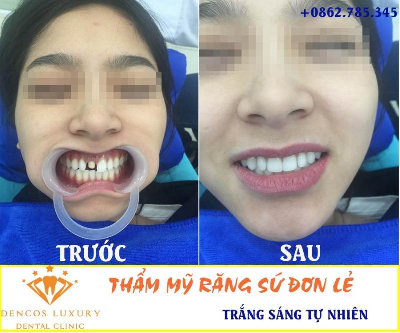 Khám phá 8 địa chỉ bọc răng sứ uy tín tại Thanh Hóa