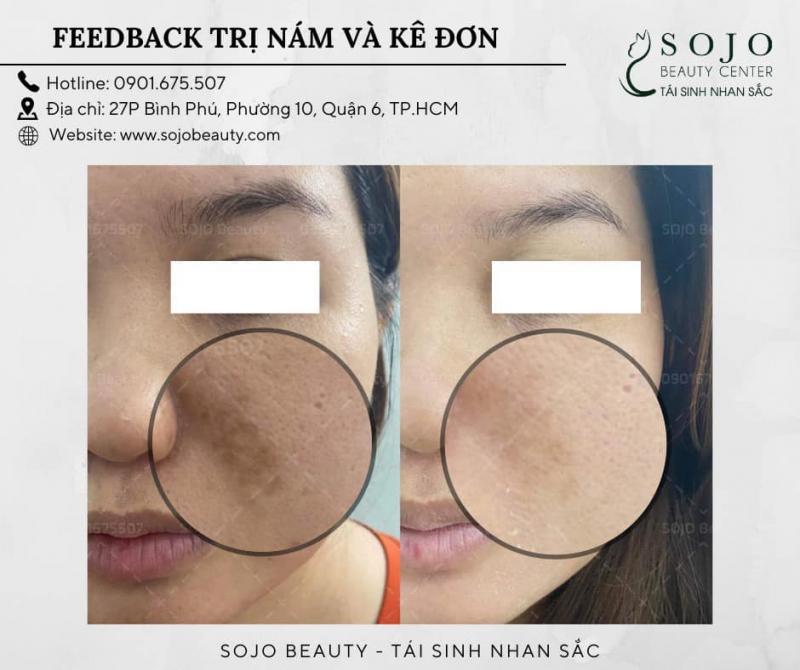 Top 3 Spa trị nám hiệu quả tại quận 6, TP. HCM