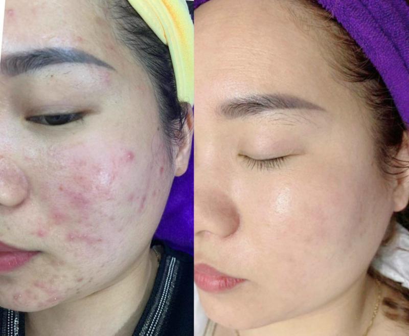 Top 6 spa trị mụn hiệu quả tại quận Ba Đình, Hà Nội
