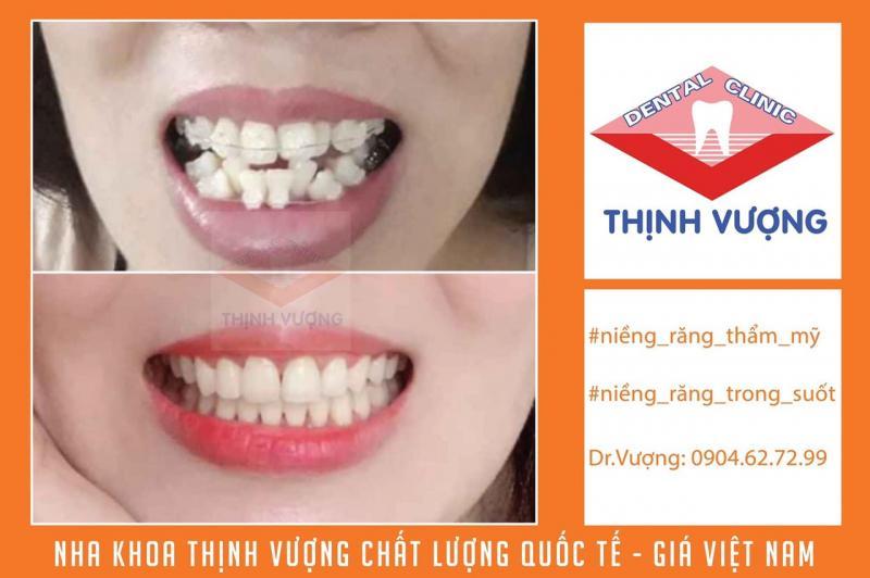 Top 10 Địa Chỉ Niềng Răng Uy Tín Và Chất Lượng Nhất Hải Phòng
