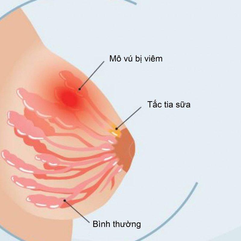 Top 4 địa chỉ khám và điều trị áp xe vú đáng tin cậy tại TP. Hồ Chí Minh