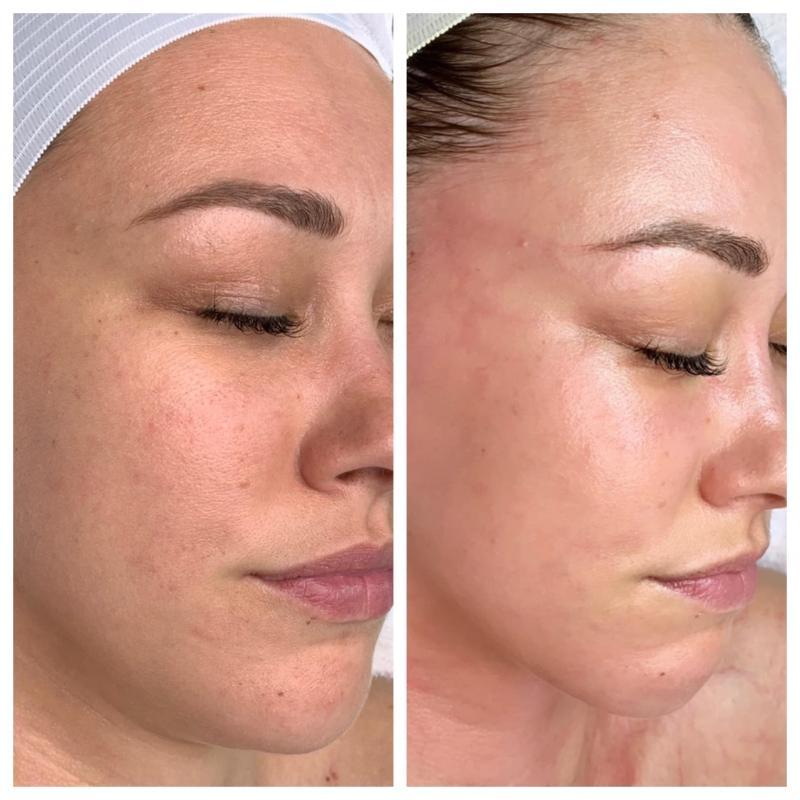 Top 5 spa trị mụn hiệu quả và đáng tin cậy tại TP. Bà Rịa