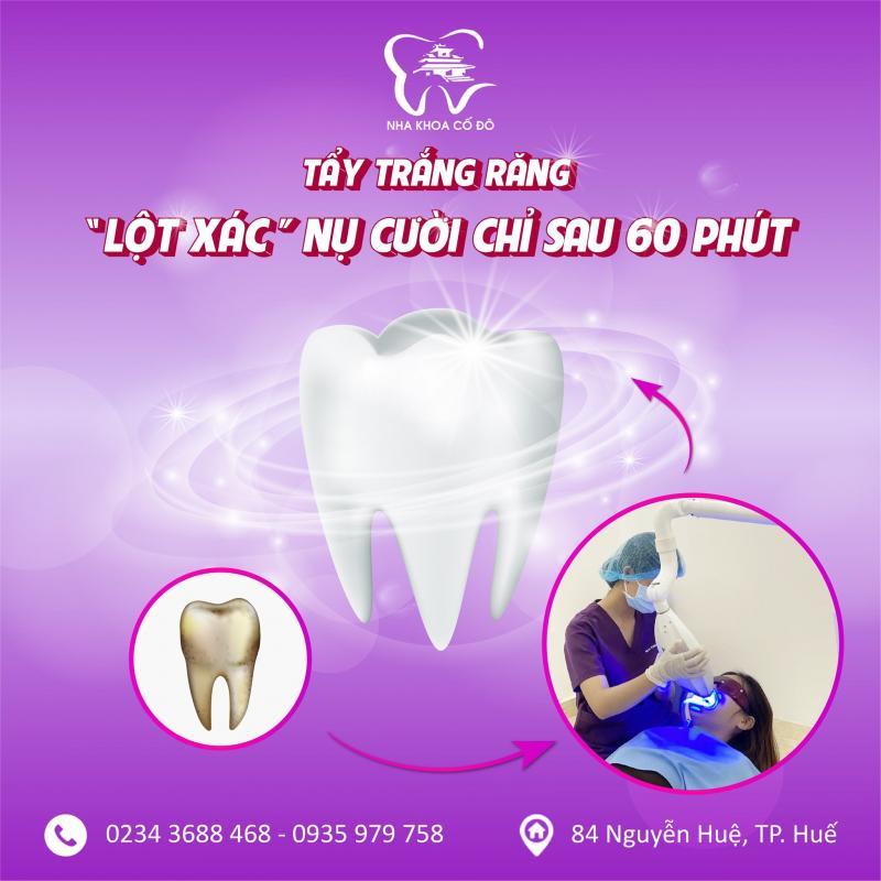 Top 8 địa chỉ tẩy trắng răng uy tín tại TP. Huế, Thừa Thiên Huế