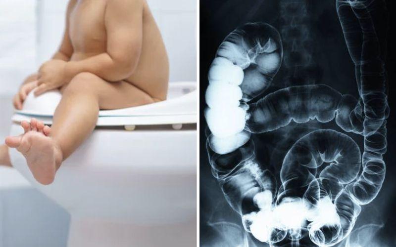 So sánh giãn ruột sinh lý và táo bón ở trẻ sơ sinh