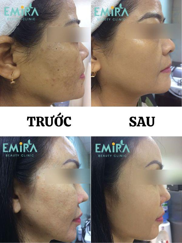 Top 5 Spa trị nám hiệu quả tại quận 10, TP. HCM