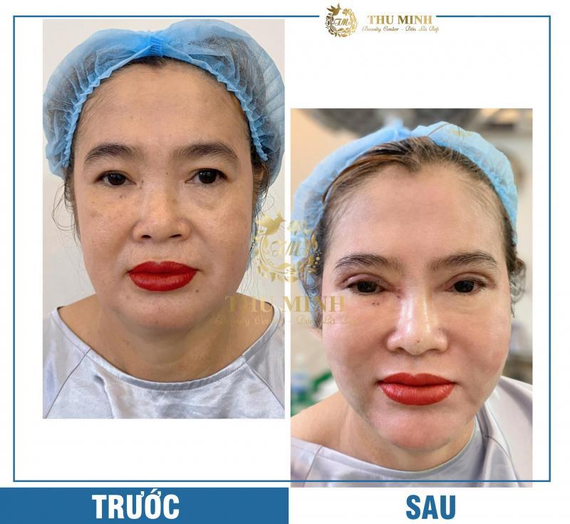 Top 8 Địa Chỉ Cắt Mí và Nhấn Mí Uy Tín, An Toàn Nhất Tại Cần Thơ