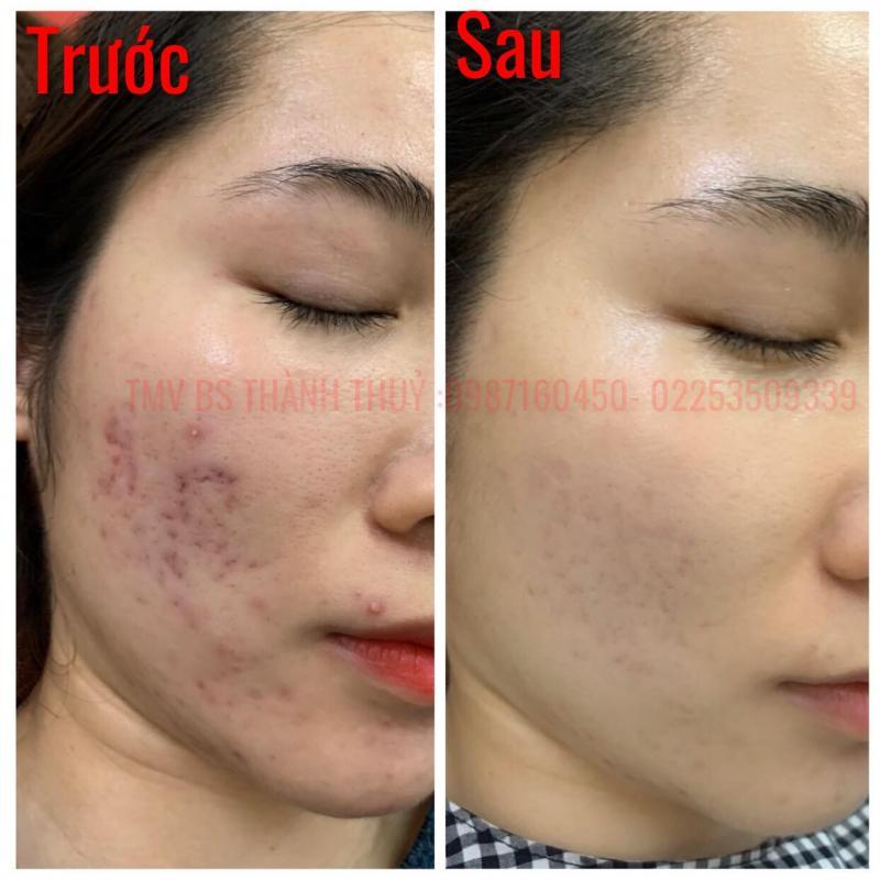 Top 6 spa uy tín chuyên trị sẹo rỗ do mụn tại Hải Phòng