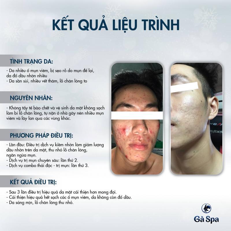 Top 7 spa uy tín tại Cần Thơ chuyên điều trị sẹo rỗ do mụn