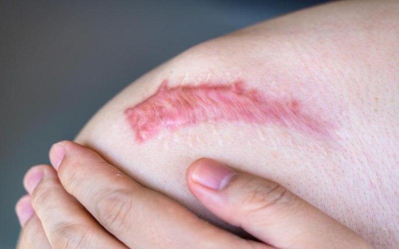 Vì sao sẹo lồi ngày càng lớn? Những cách điều trị bạn nên biết