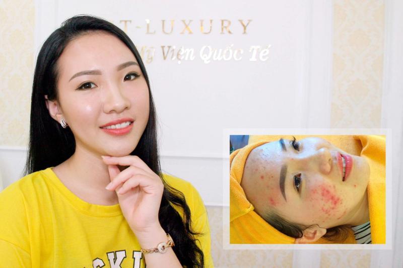 Top 10 Địa chỉ điều trị mụn uy tín và hiệu quả nhất tại TP. Hạ Long, Quảng Ninh