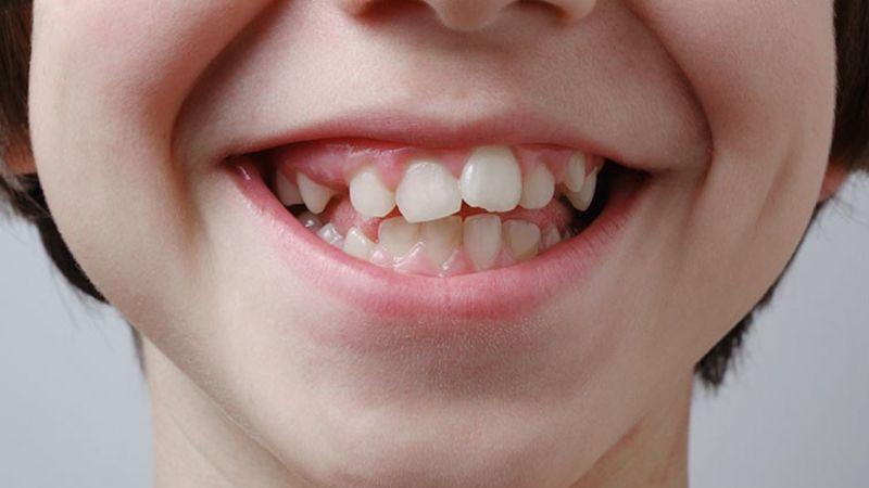 Lệch khớp cắn là gì? Nguyên nhân dẫn đến tình trạng sai lệch khớp cắn