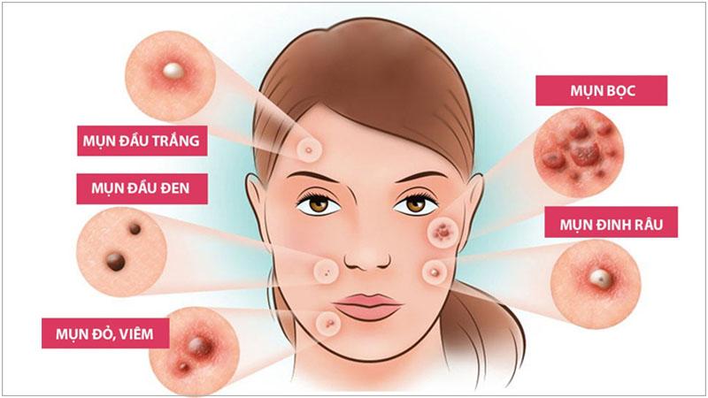 Trà Atiso và Cao Atiso có thật sự giúp trị mụn?
