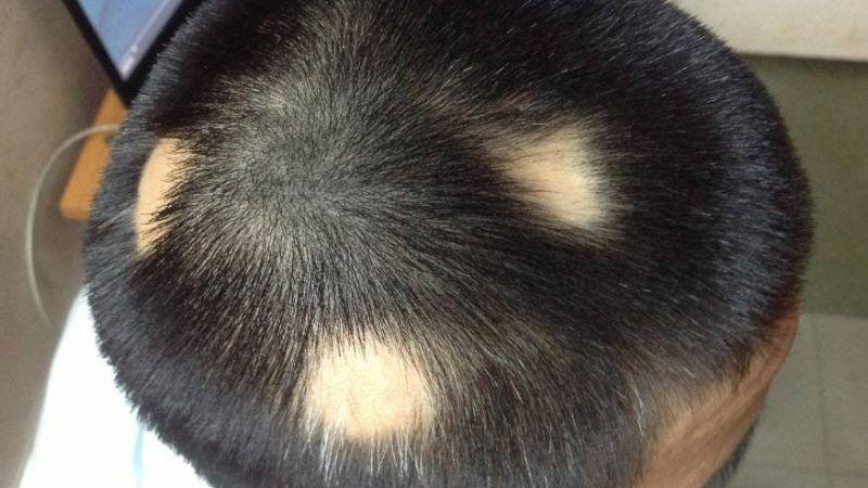 Các dạng rụng tóc phổ biến ở trẻ em mà ba mẹ cần nắm rõ để phòng ngừa hiệu quả