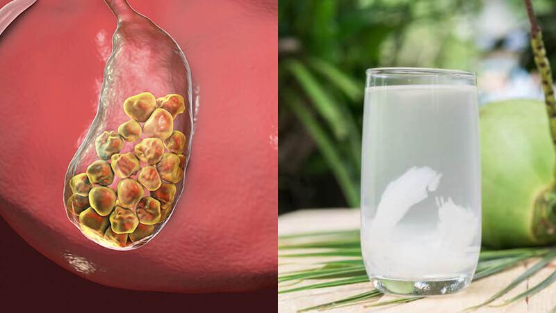 Phương pháp chữa sỏi mật bằng nước dừa có thật sự hiệu nghiệm?