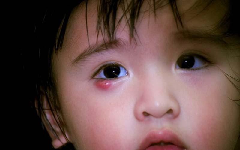 Tại sao trẻ lại dễ bị mắc bệnh lẹo mắt? Và liệu việc chích lẹo có đau đớn hay không? Những thắc mắc này sẽ được Tripi giải đáp ngay trong bài viết sau.
