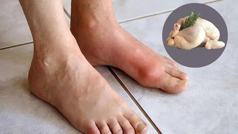 Người mắc bệnh gút có nên ăn thịt gà hay không?