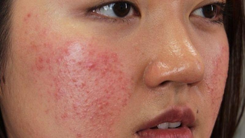 10+ tác hại của lăn kim mà nàng không thể bỏ qua