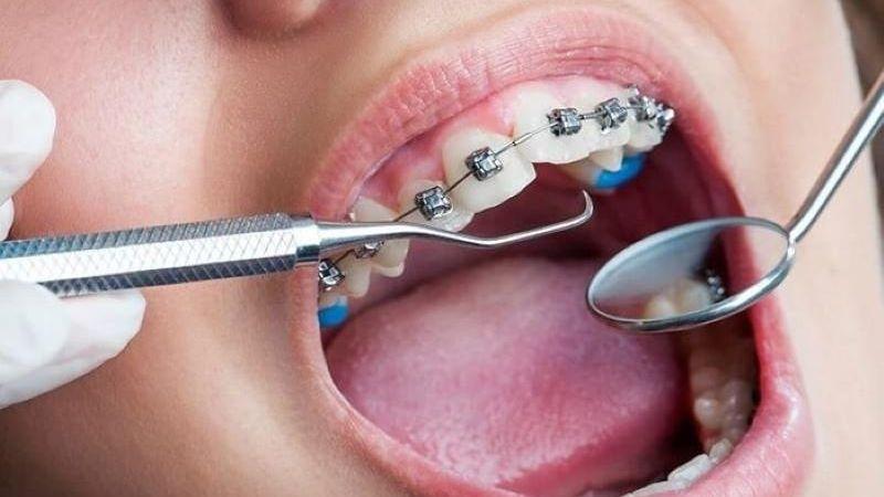 Khoảng cách giữa các lần siết răng khi niềng là bao lâu? Bí quyết giảm đau hiệu quả sau mỗi lần siết răng