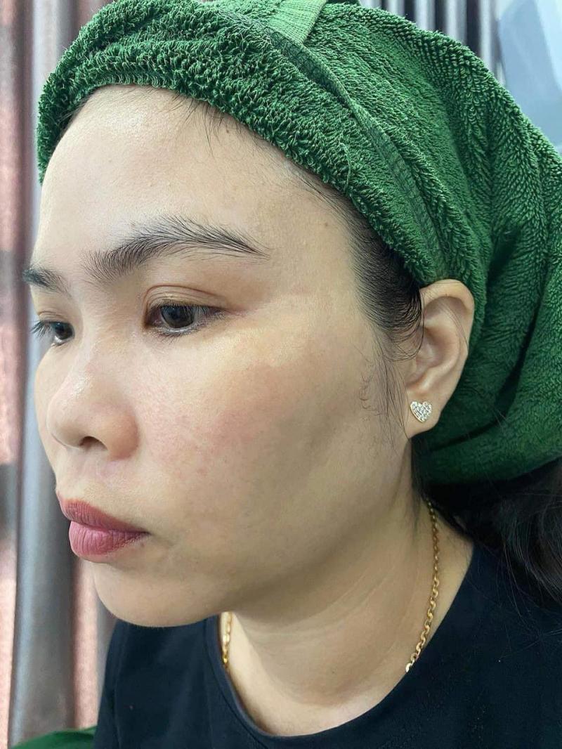 Top 5 spa điều trị nám hiệu quả nhất tại Thái Bình