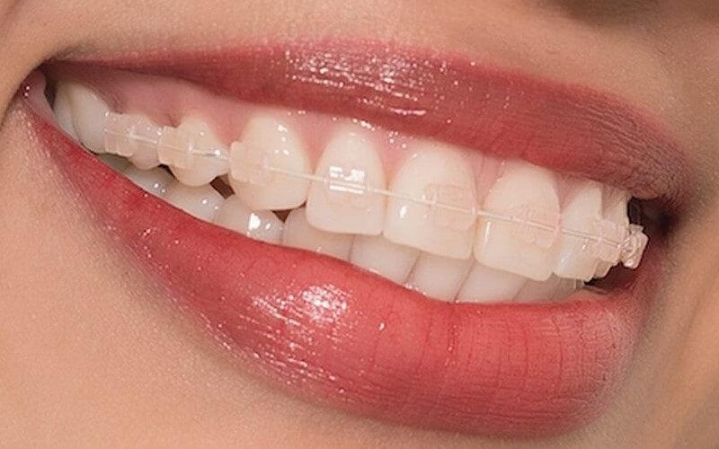 Top 10 nha khoa uy tín cung cấp dịch vụ niềng răng mắc cài sứ dây trong tại TP. Biên Hòa, Đồng Nai