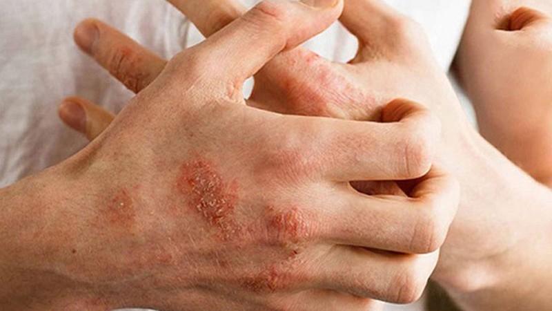 Dấu hiệu và phương pháp phòng ngừa dị ứng thời tiết hiệu quả