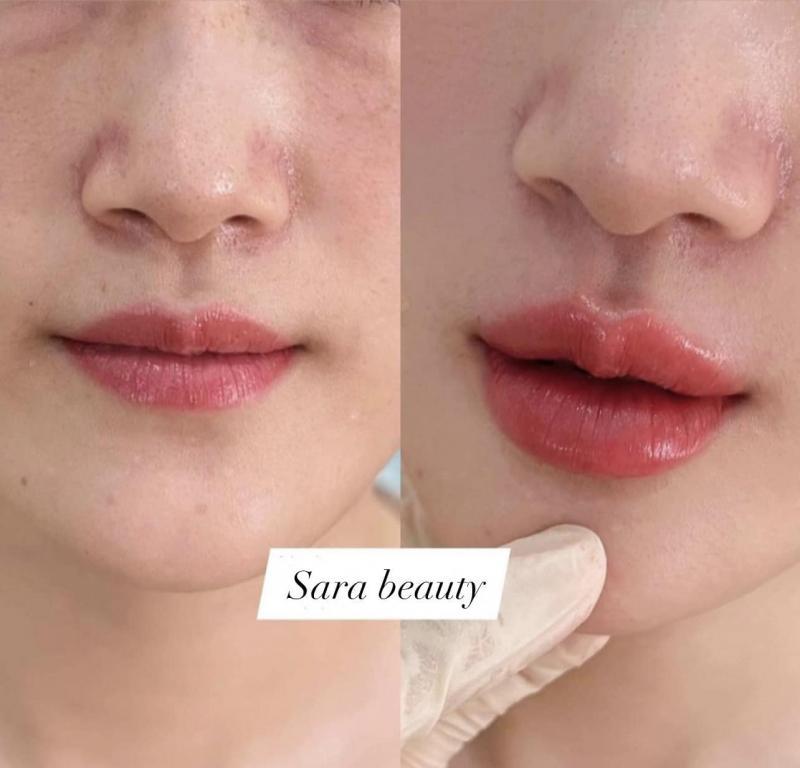 Top 10 địa chỉ tiêm môi đẹp và uy tín nhất tại Đà Nẵng