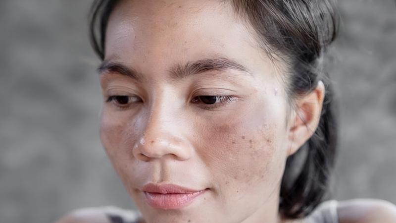Tìm hiểu nguyên nhân và giải pháp giảm nám da hiệu quả cho phụ nữ sau sinh