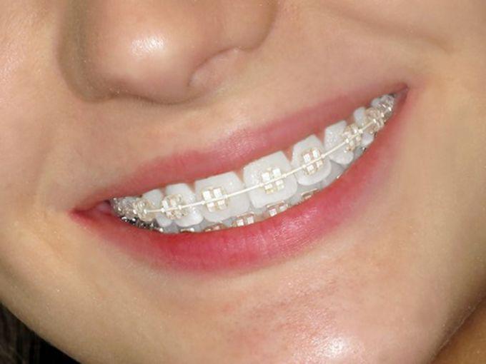Top 8 nha khoa uy tín chuyên niềng răng mắc cài sứ dây trong tại Cần Thơ