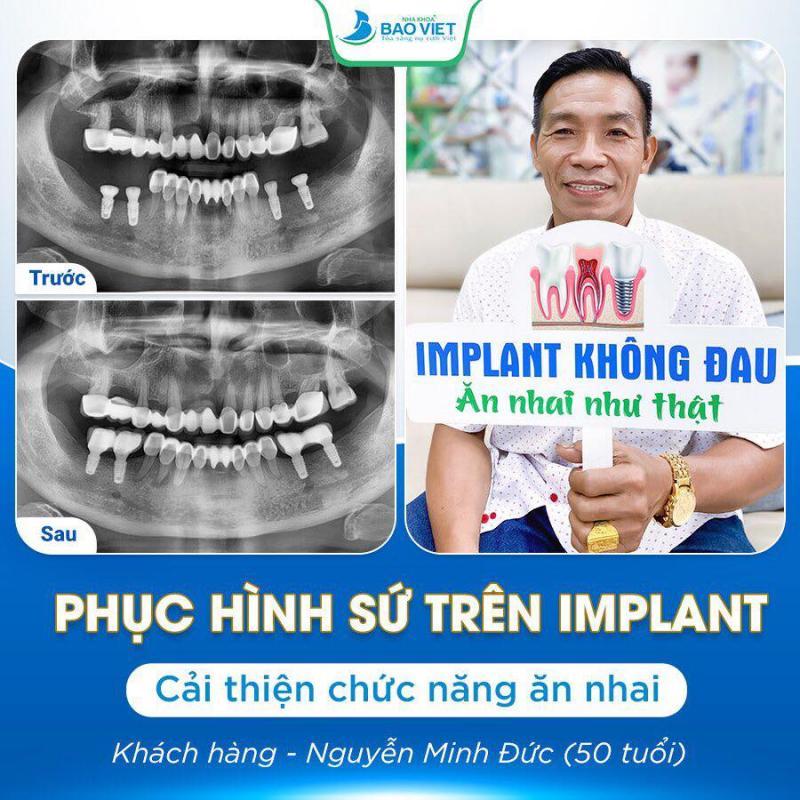 Top 9 nha khoa hàng đầu tại TP.HCM chuyên trồng răng implant cho người trung niên