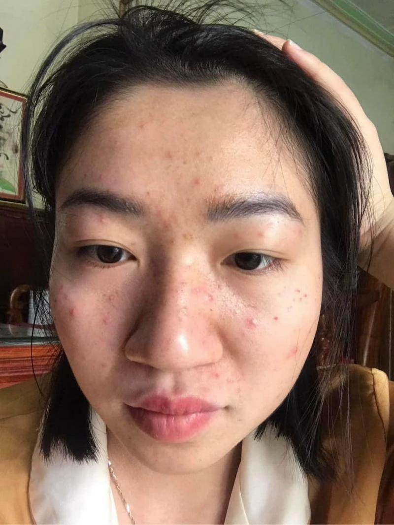 Top 5 Spa Trị Mụn Hiệu Quả Nhất Tại Vĩnh Phúc