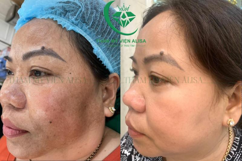 Top 8 Spa Chuyên Điều Trị Nám Tốt Nhất tại Cần Thơ