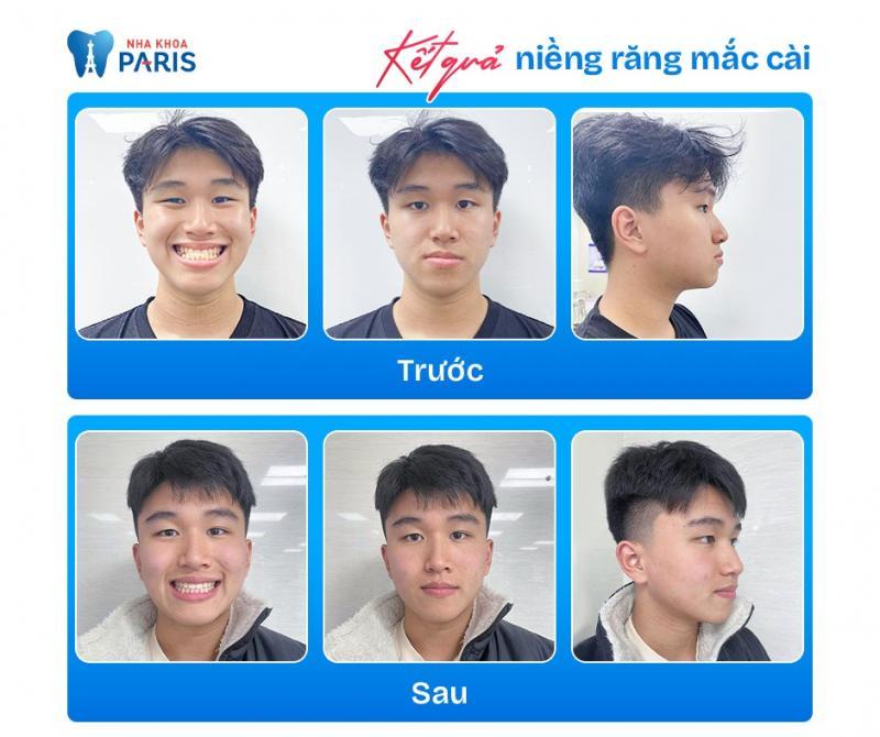 Top 10 địa chỉ niềng răng đáng tin cậy nhất tại Bắc Ninh
