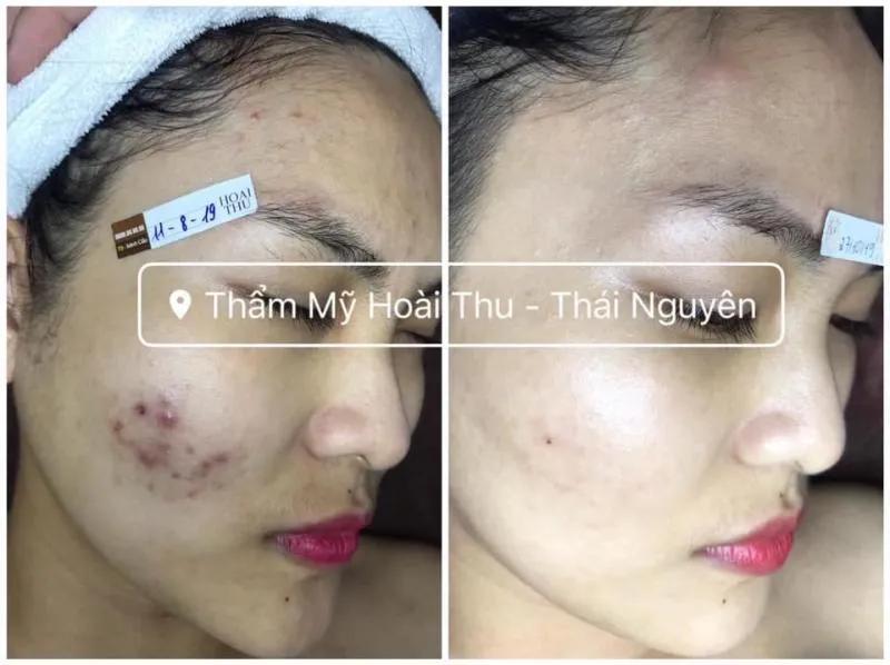 Top 8 địa chỉ Spa trị mụn hiệu quả nhất tại Thái Nguyên