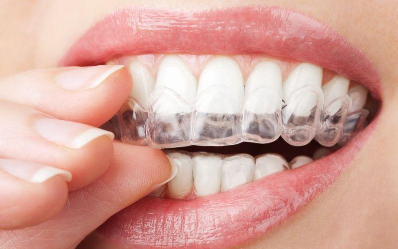 Niềng răng trong suốt là một phương pháp chỉnh nha tiên tiến, giúp bạn có được nụ cười hoàn hảo mà không làm mất đi vẻ tự nhiên. Khám phá những ưu nhược điểm của phương pháp này để có quyết định đúng đắn cho hàm răng của bạn.