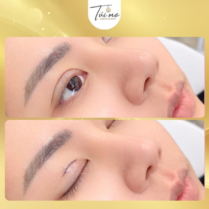 Top 4 địa chỉ nhấn mí, cắt mí đẹp và an toàn tại quận 5, TP. HCM