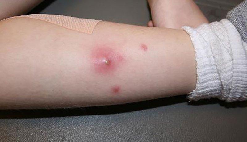 Khám phá sự thật ít biết về mụn nhọt: Định nghĩa và những bí mật không phải ai cũng rõ