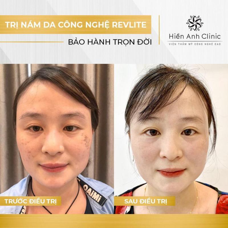 Top 6 spa trị nám hiệu quả nhất tại Quận 5, TP. HCM