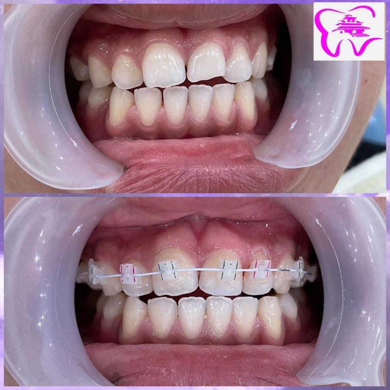 Top 5 địa chỉ niềng răng mắc cài sứ dây trong uy tín tại Thừa Thiên Huế