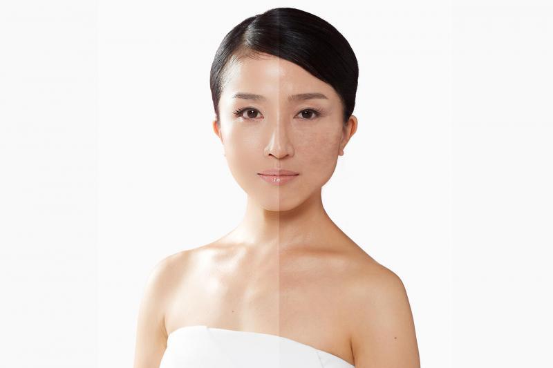 10 Công nghệ trị nám đột phá nhất hiện nay bạn không nên bỏ qua