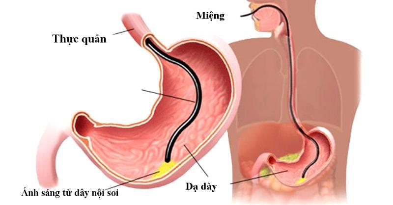 10 Dấu hiệu thường gặp của bệnh viêm loét dạ dày - tá tràng