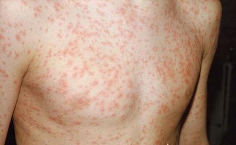 Top 8 Nguyên nhân gây phát ban và phương pháp xử trí hiệu quả