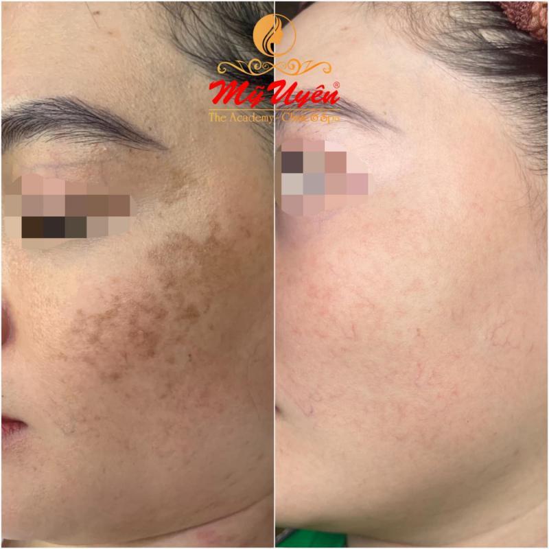 9 Địa chỉ trị nám uy tín và chất lượng nhất tại Bạc Liêu