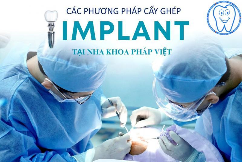 Top 8 địa chỉ trồng răng Implant chất lượng nhất tại Quảng Bình