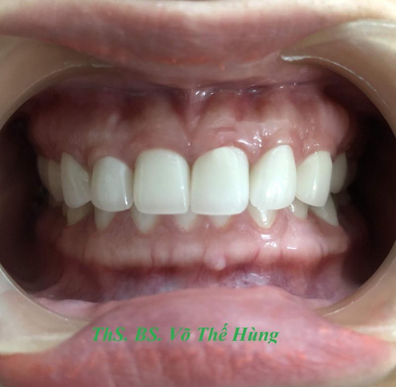 Top 8 địa chỉ bọc răng sứ chất lượng và uy tín hàng đầu tại Quảng Nam